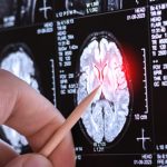 Çok nadir görülen yeni bir nörolojik hastalık keşfedildi: Sadece 13 kişide görüldü!