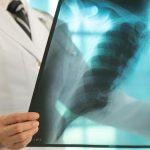 Erken teşhis önemli! Akciğer kanserinin belirtileri nelerdir? Öksürük, göğüs ağrısı, halsizlik, balgamda kan… –