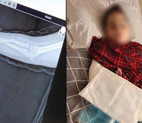 Okulda zorbalık: 9 yaşındaki çocuk arkadaşıyla kavga etti, kolu kırıldı